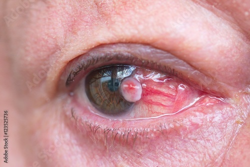 Close up of the conjunctival squamous cell carcinoma. photo