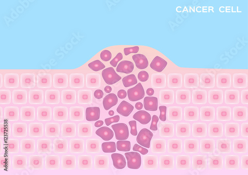 Cancer cell in a growing tumor vector , pink cancer