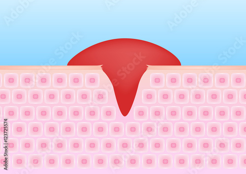 wound skin vector graphic . the blood come out of wound , bleeding
