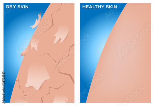 Dry skin and healthy skin texture , vector