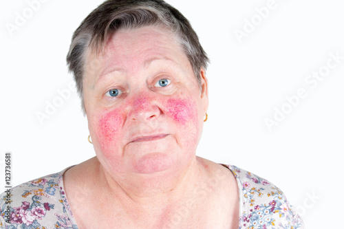 Rosacea, facial skin disorder, portrait of unhappy elderly woman