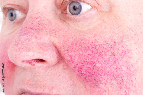 Rosacea, facial skin disorder, portrait of unhappy elderly woman photo