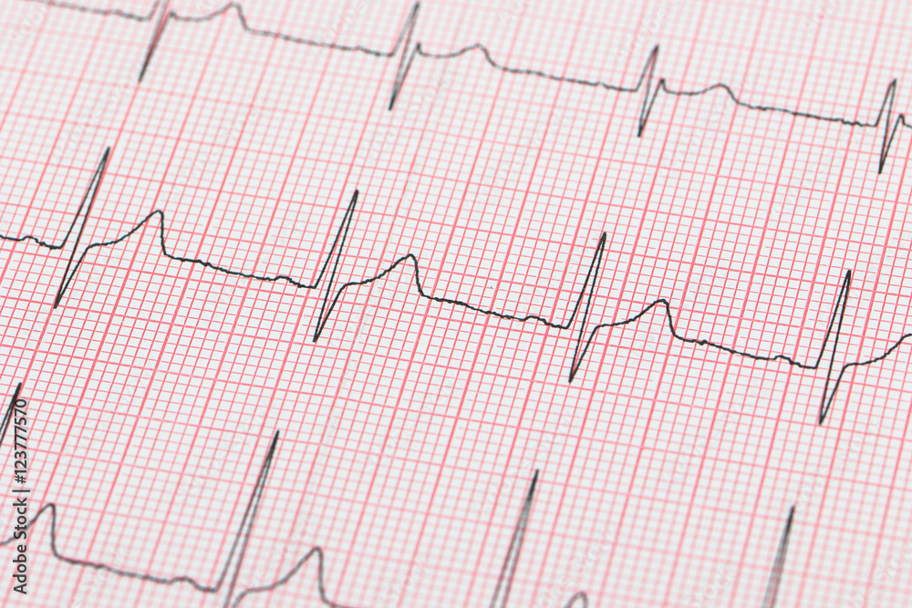 Elektrokardiogramm EKG Aufzeichnung der Herzfrequenz Elektrokardiogramm EKG Aufzeichnung der Herzfrequenz
