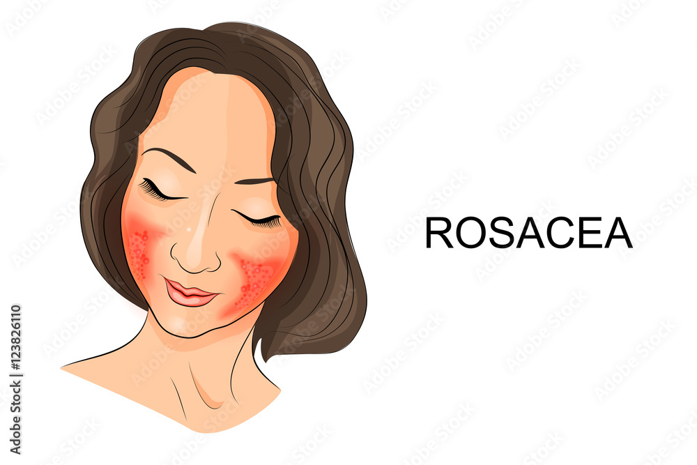 rosacea on the girl's face. Dermatology
