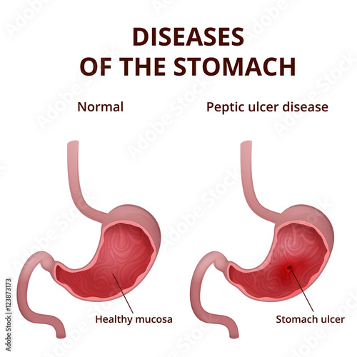 Anatomy of the human healthy and unhealthy stomach