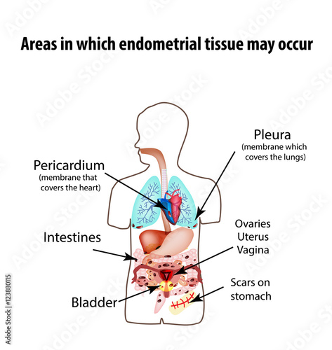 Areas in which endometrial tissue can appear. Endometriosis. Endometriosis in the body. The structure of the lungs, heart, intestine, stomach, liver, pelvic organs. Silhouette. Infographics Vector