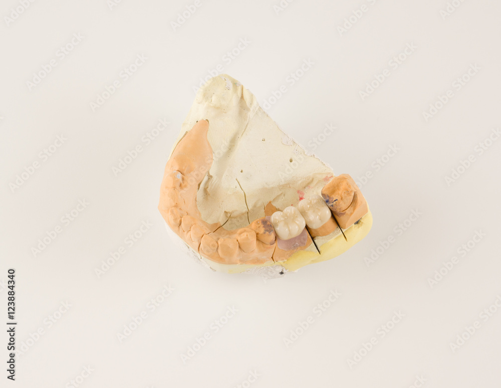 Obraz premium dental prosthesis manufacturing step