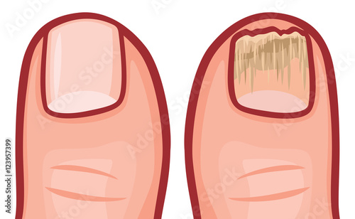 fungal infection of the nails vector illustration