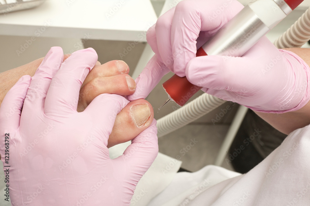 Doctor Podiatry removes calluses, corns and treats ingrown nail. Hardware manicure. Concept body care.
Doctor Podiatry removes calluses, corns and treats ingrown nail. Hardware manicure. Concept body care.