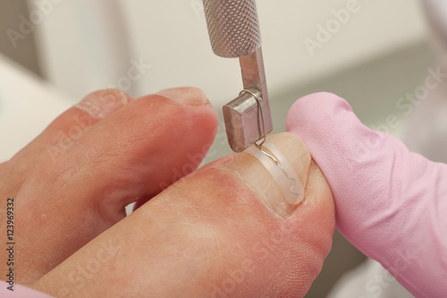 Doctor Podiatry removes calluses, corns and treats ingrown nail. Hardware manicure. Concept body care.
 photo