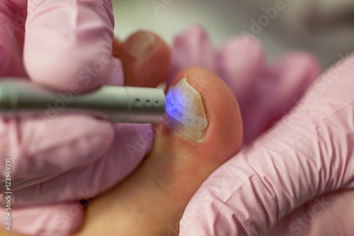 Doctor Podiatry removes calluses  corns and treats ingrown nail. Hardware manicure. Concept body care.  