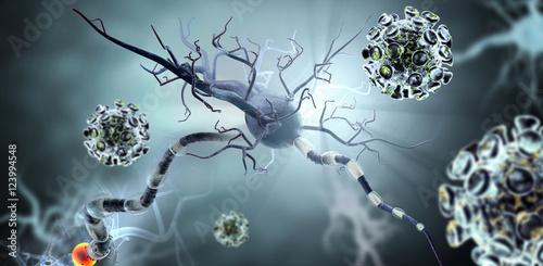 Damaged nerve cells, concept for neurodegenerative and neurological disease, tumors, brain surgery. photo