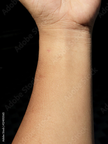 skin arm black background © srckomkrit