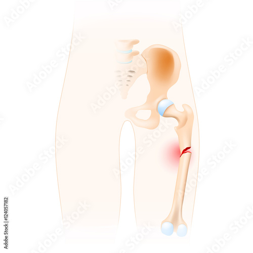 Fractured Femur