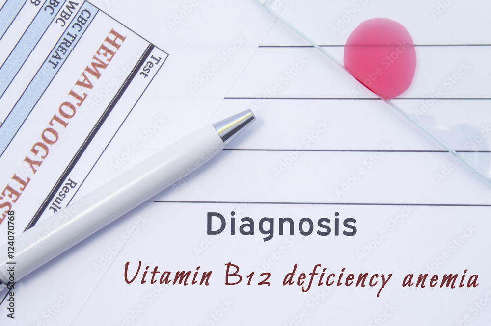 Diagnosis Vitamin B12 deficiency anemia. Written by doctor hematological diagnosis Vitamin B12 deficiency anemia in medical report, which are result of blood test and glass slide with blood smear Diagnosis Vitamin B12 deficiency anemia. Written by doctor hematological diagnosis Vitamin B12 deficiency anemia in medical report, which are result of blood test and glass slide with blood smear