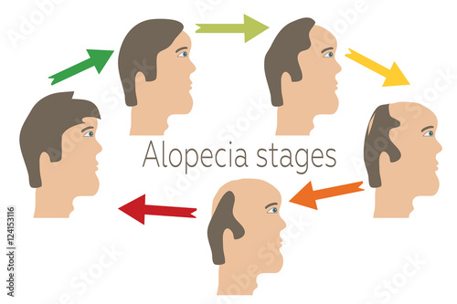 Alopecia stages set. Front view of a man losing hair. Male baldness. Male hair loss pattern.  Hair care concept. Vector illustration.