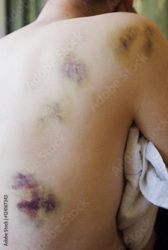 Bruising On A Woman's Back And Shoulder