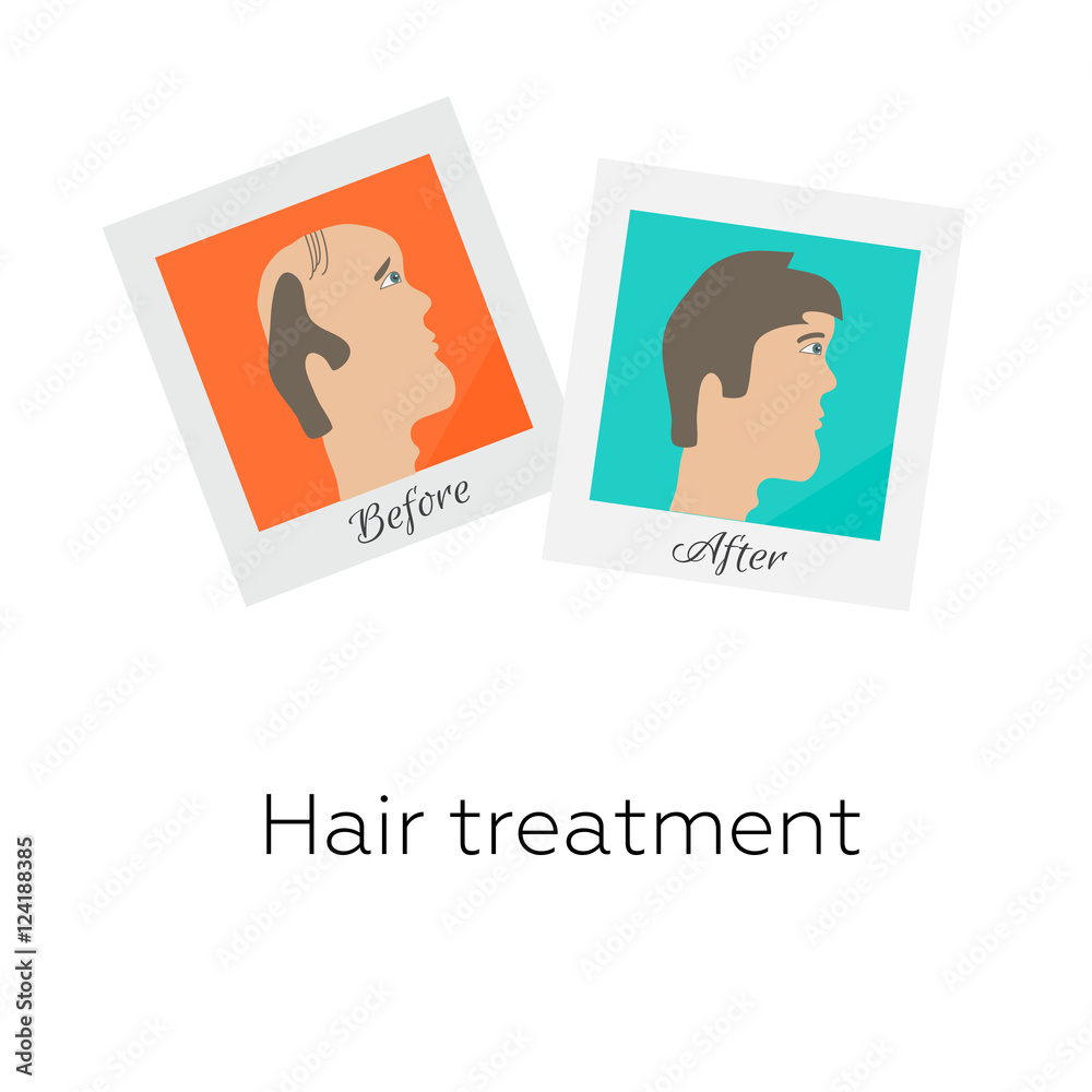 Vector illustration of two photographs of a man before and after hair treatment and hair transplantation. Male hair loss design template. Alopecia medical concept.