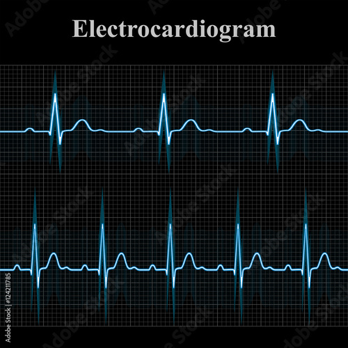 Normal and tachycardial ecg charts