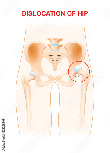 Dislocation of hip