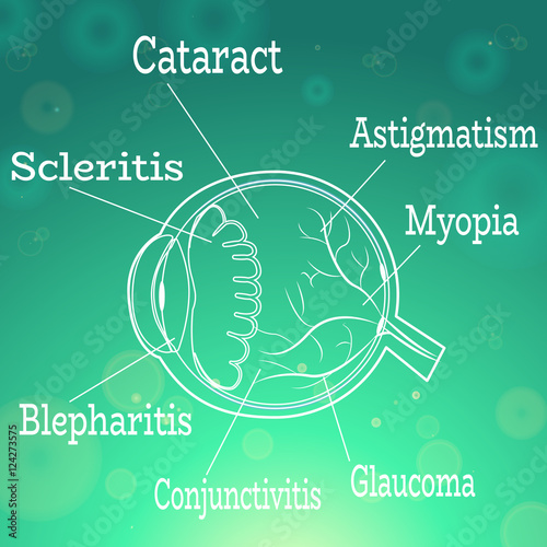 Human eye diseases anatomy structure.Medical infographics for ophthalmology clinic,vector illustration.List of ailments - cataract, astigmatism,myopia,glaucoma with eye anatomy for optician clinic