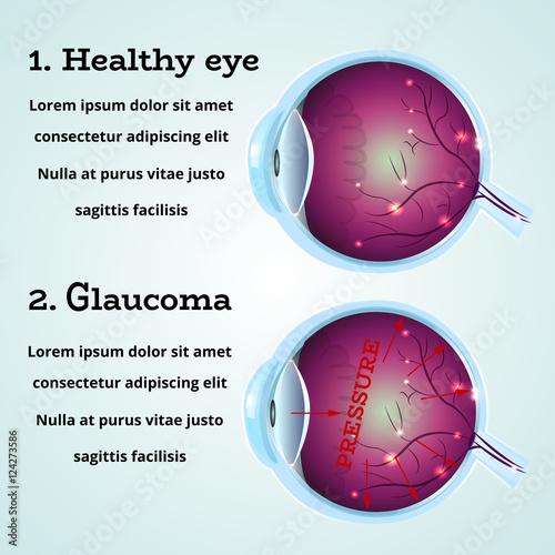 Human healthy eye and Glaucoma disease anatomy structure.Medical infographics for ophthalmology clinic,vector illustration.Cause of Glaucoma on eye cross section - high level pressure,white wallpaper.