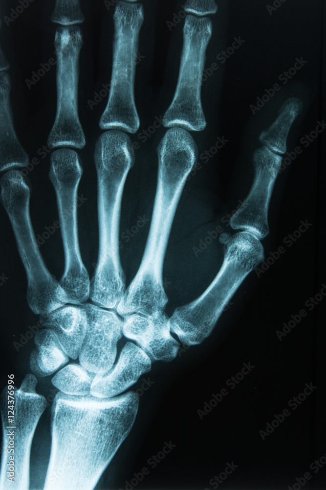 Röntgenaufnahme Hand rechts