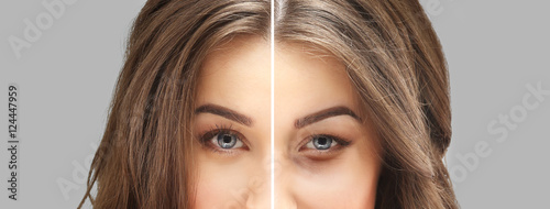 Cuadro en lienzo Lower Eyelid Blepharoplasty.