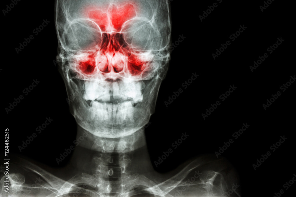 Sinusitis. film x-ray skull AP ( anterior - posterior ) show infection and inflammation at frontal sinus , ethmoid sinus , maxillary sinus and blank area at right side