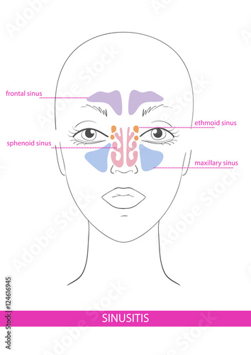 nasal sinus. inflammation