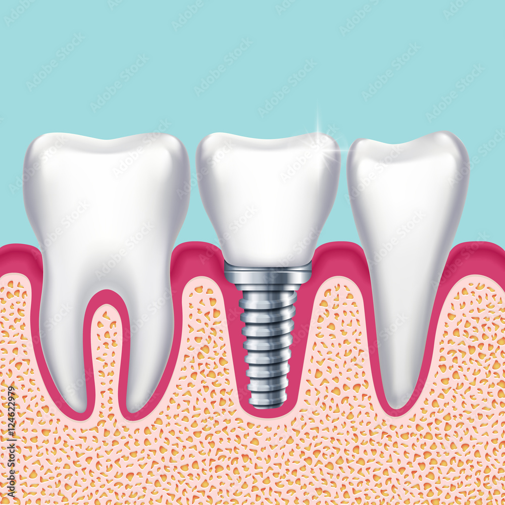 Human teeth and dental implant in jaw orthodontist medical vector illustration Human teeth and dental implant in jaw orthodontist medical vector illustration