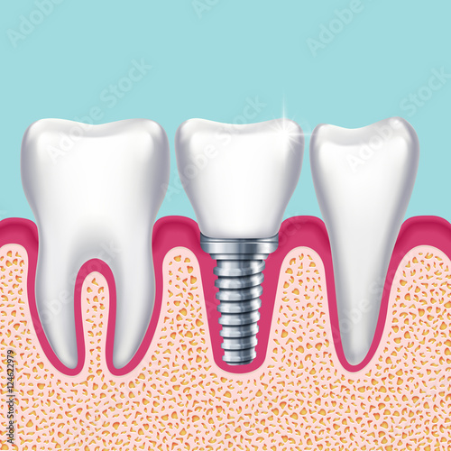 Human teeth and dental implant in jaw orthodontist medical vector illustration