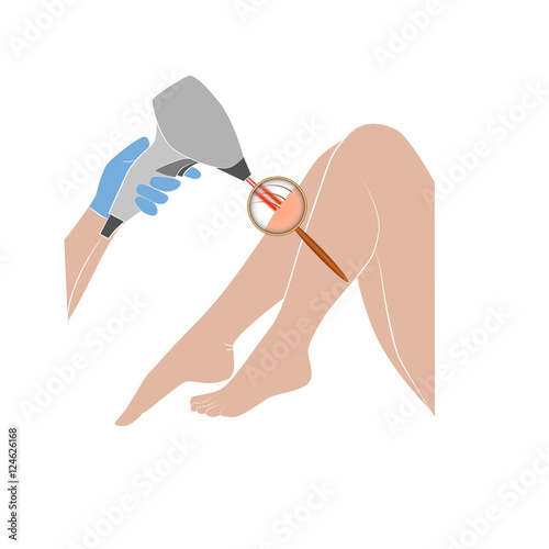 laser hair removal. The increase under the lens