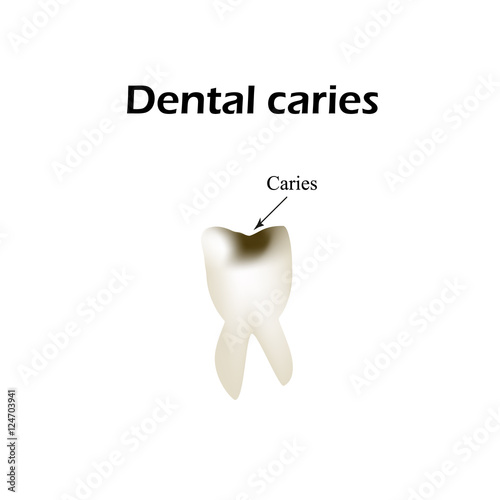 Deep tooth decay. Vector illustration on isolated background