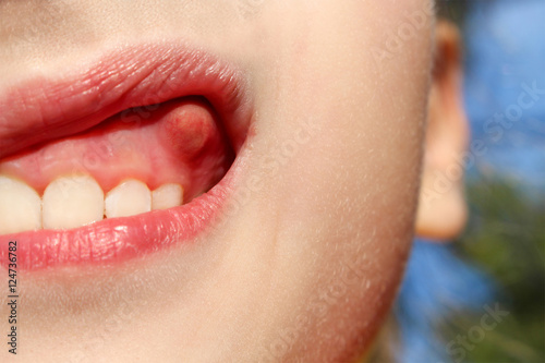 Photography Swelling on gums the child.
