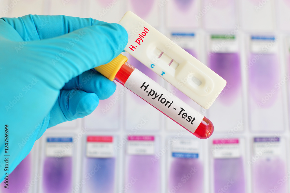 H. pylori testing by using rapid test cassette, the result showed positive
