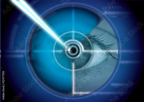 Eye laser