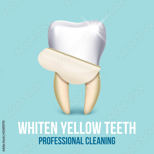 Tooth veneer whitening dental technician vector concept