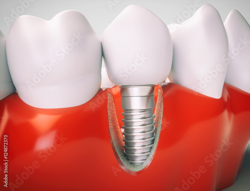 Dental implant - 3d rendering