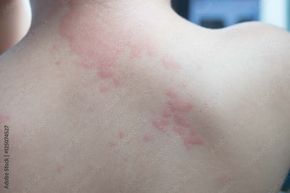Fototapeta premium Close up image of boy's body suffering severe urticaria, nettle