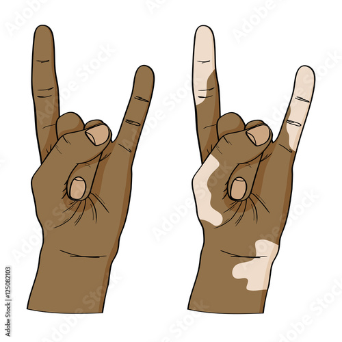 Vitiligo disease. Vector woman's hands isolated on white background.