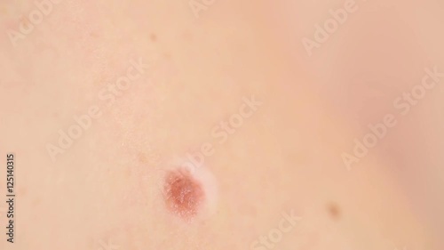 close up of mole on human skin. large birthmark