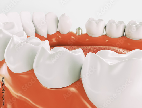 Dental implant - Series 3 of 3 - 3d rendering photo