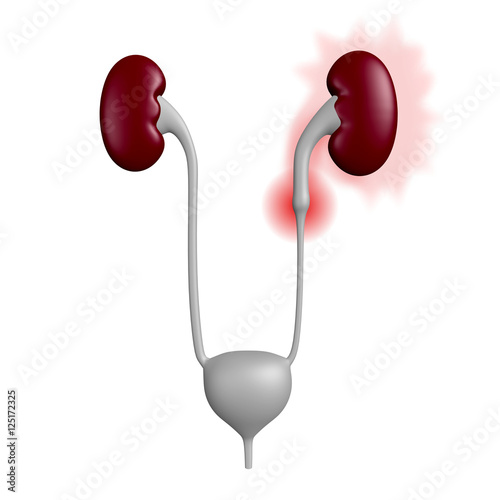 Fotografi 3D illustration of urinary tract with a stone blocking one of the ureters