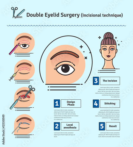Vector Illustrated set with double eyelid surgery