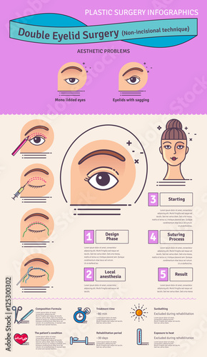 Vector Illustrated set with double eyelid surgery. Non-incisional technique