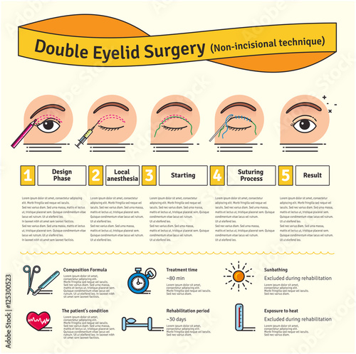 Vector Illustrated set with double eyelid surgery. Non-incisional technique