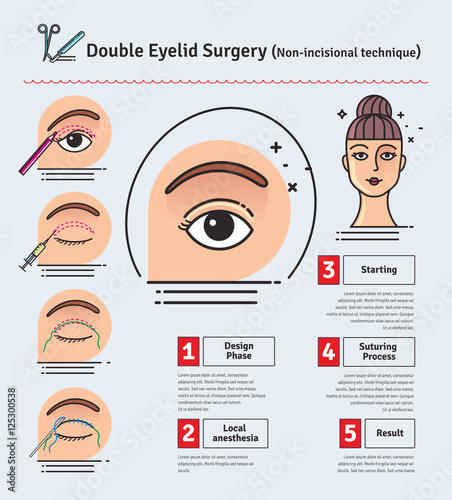 Vector Illustrated set with double eyelid surgery. Non-incisional technique
