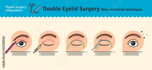 Vector Illustrated set with double eyelid surgery. Non-incisional technique