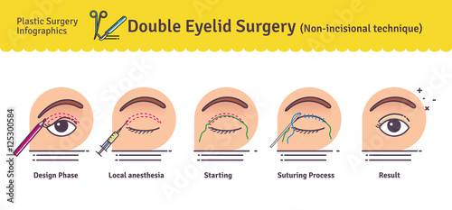 Vector Illustrated set with double eyelid surgery. Non-incisional technique